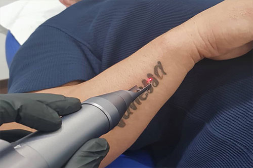Best Laser Tattoo Removal Service Treatment in Brevard | Melbourne FL