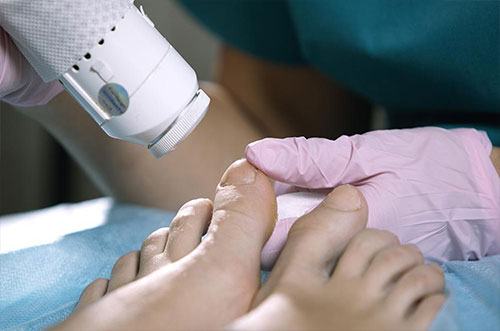 Laser Toe Nail Fungus Removel services in Melbourne FL by Tatts No Good